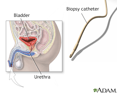 Bladder biopsy