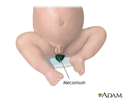 Meconium