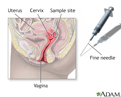 Cervix needle sample