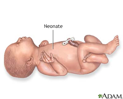 Neonate