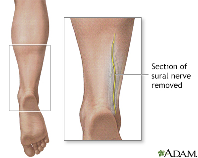 Nerve biopsy