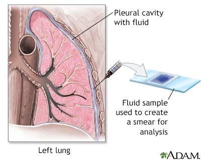 Pleural smear