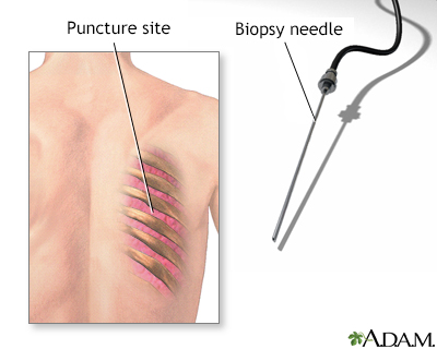 Lung biopsy