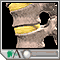 Herniated nucleus pulposus (slipped disk)