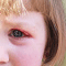 Treating eyelid bumps