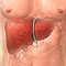 Alcoholic liver disease