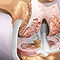 Arthritis