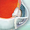 Cataracts