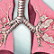 Lung cancer