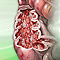 Crohn disease