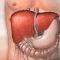 Hepatitis A