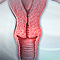 Cervical cancer