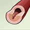 Cardiac and vascular disorders: Blood clots