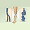 Varicose veins overview