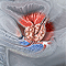 Prostate cancer