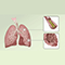 Overview of chronic obstructive pulmonary disease (COPD)