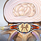 Spinal stenosis