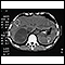 Adrenal Tumor - CT