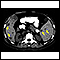 Spleen metastasis - CT scan