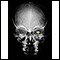 Neurofibromatosis I - enlarged optic foramen