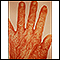 Scabies rash and excoriation on the hand