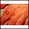 Cryptococcus - cutaneous on the hand