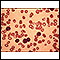 Chronic lymphocytic leukemia - microscopic view