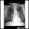 Adenocarcinoma - chest x-ray