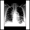 Sarcoid, stage IV - chest x-ray