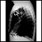 Pulmonary mass - side view chest X-ray