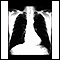 Bronchial cancer - chest X-ray