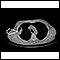 Lung mass, right lung - CT scan