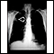 Lung mass, right upper lung - chest X-ray