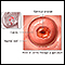 Cervical erosion