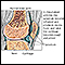 Rheumatoid arthritis