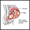 Congenital cytomegalovirus