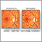 Diabetic retinopathy