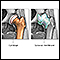 Osteoarthritis vs. rheumatoid arthritis