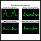 Post myocardial infarction ECG wave tracings