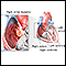 Right atrial myxoma