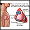 Pericarditis post-IM