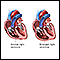 Tricuspid Regurgitation