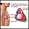 Cardiac tamponade