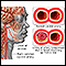 Carotid dissection