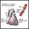 Coronary artery spasm