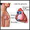 Constrictive pericarditis