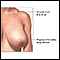 Breast reduction (mammoplasty) - series - Indications