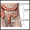 Ulcerative colitis