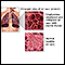 COPD (chronic obstructive pulmonary disorder)