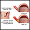 Gastroesophageal reflux disease